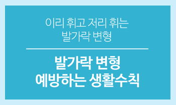 이리 휘고 저리 휘는 발가락 변형, 예방하는 생활 수칙