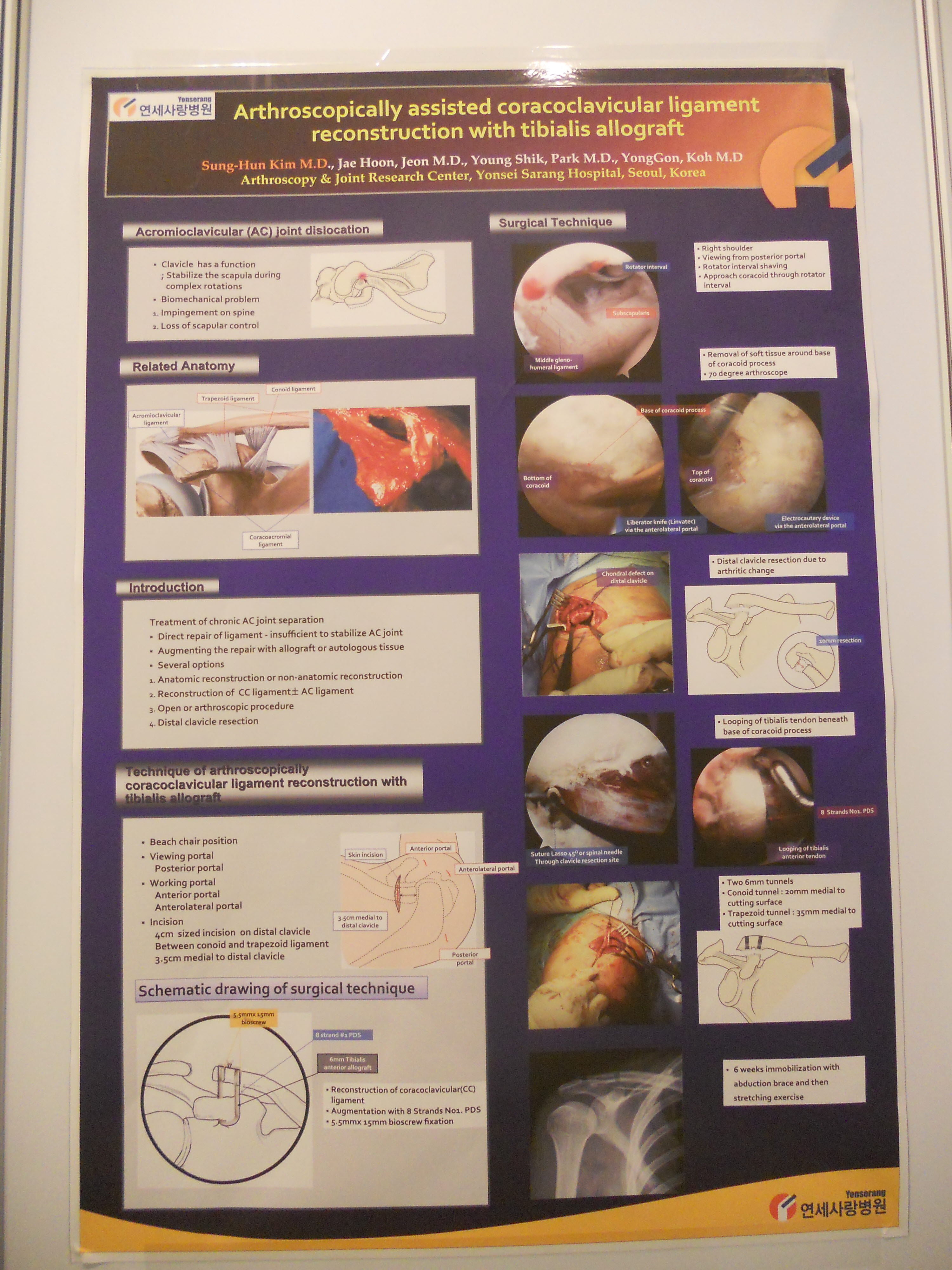 [2010 대한정형외과학회 포스터부문] 동종 경골건을 이용한 관절 내시경적 오구 쇄골 인대 재건술 게시글의 1번째 첨부파일입니다.