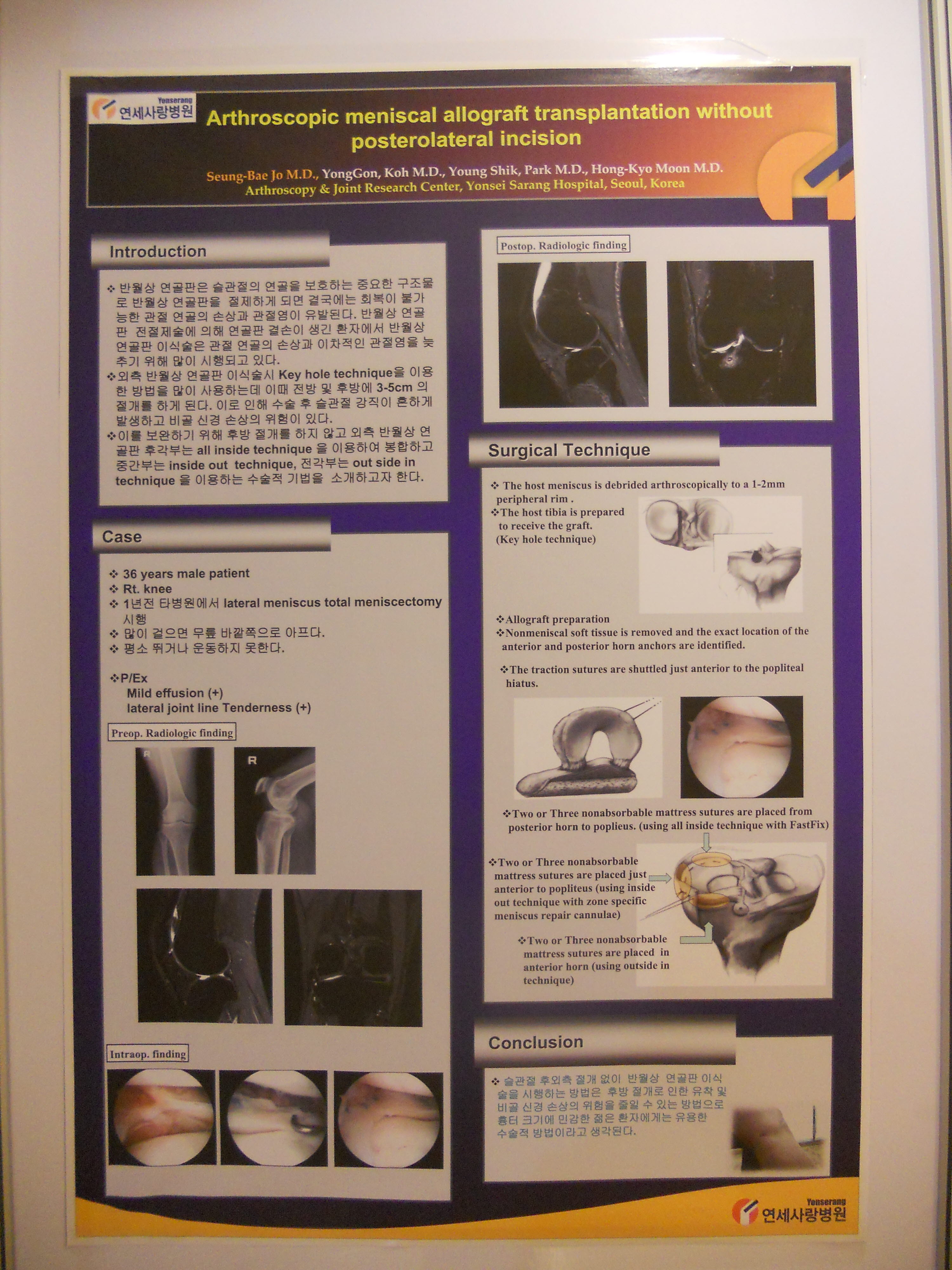 [2010 대한정형외과학회 포스터부문]후방 절개 없이 시행한 외측 반월상 연골판 이식술 게시글의 1번째 첨부파일입니다.