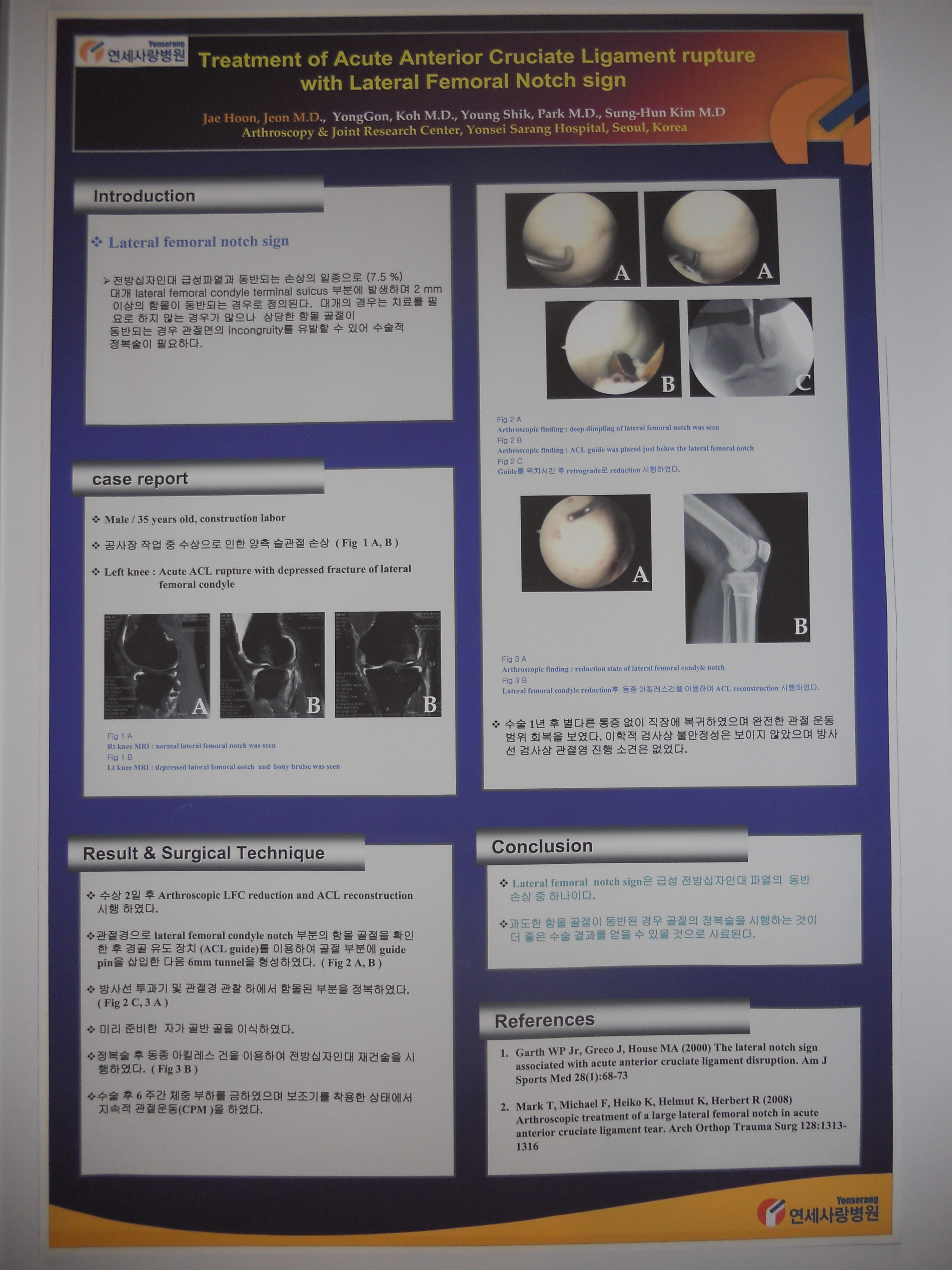 [2010 대한정형외과학회 포스터부문] 급성 전방십자인대 손상과 동반된 대퇴골 외측과 절흔 증후의 치료 게시글의 1번째 첨부파일입니다.