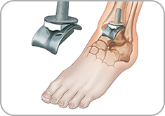 발목 인공관절 수술