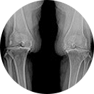 퇴행성관절염 말기로 심한 연골 손상과 부기, 다리 모양 변형이 발생한 경우