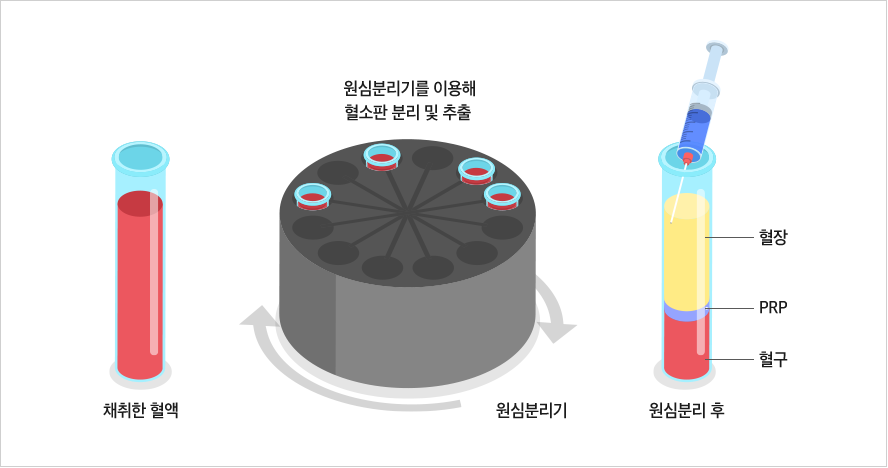 PRP(혈소판 풍부혈장) 주사란?